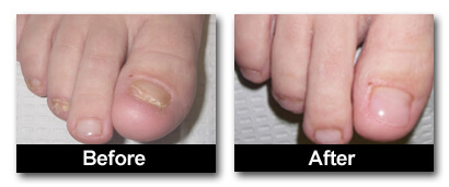 keryflex nail restoration system