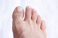 What Is Capsulitis of the Second Toe?