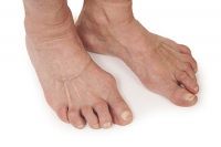Pain in the Joints of the Feet