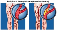 Dealing With Peripheral Artery Disease